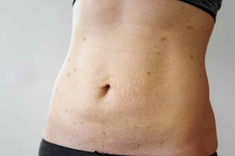 fibrosis after liposuction on woman belly
