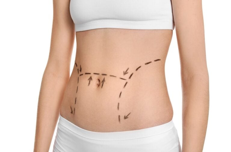 woman with liposuction lines on belly