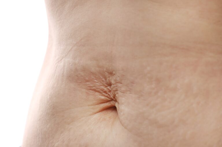 close up of a woman belly with fibrosis