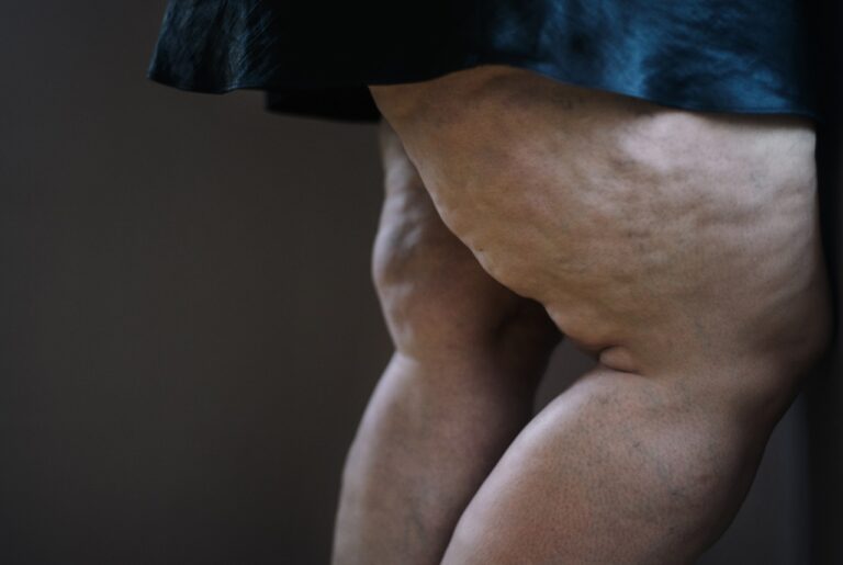 lipedema sideview fat woman