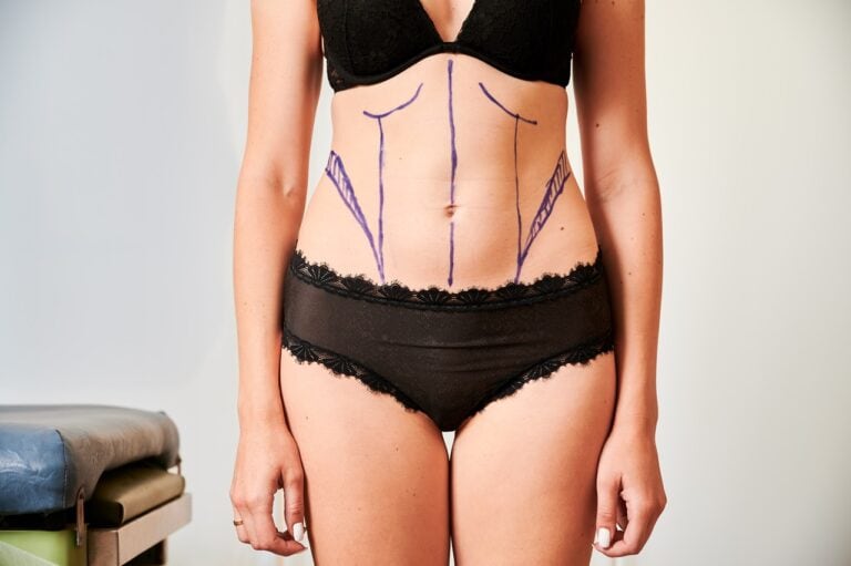 purple marks on patient in black underwear