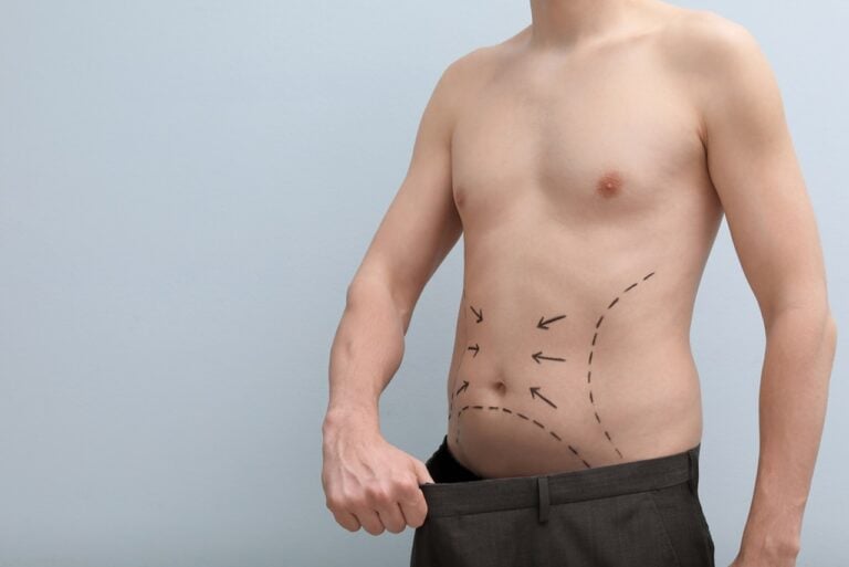 man lose pants after liposuction