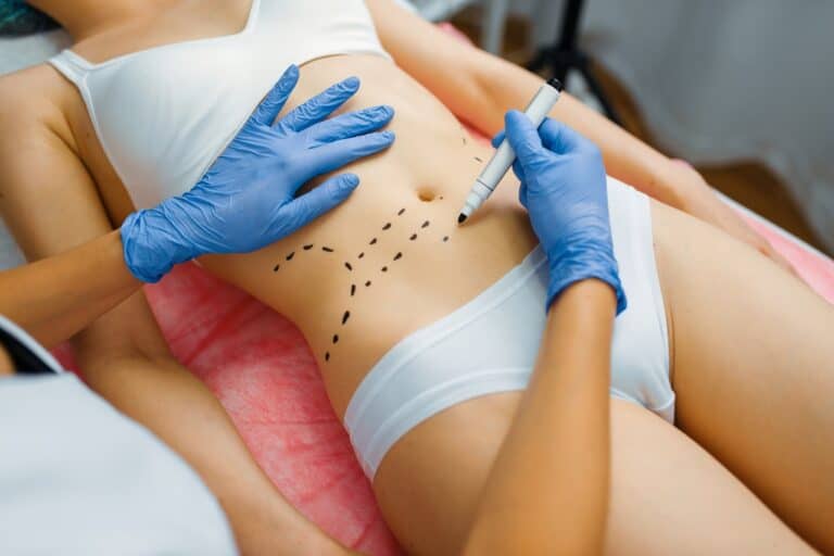 surgeon applies marks on patient