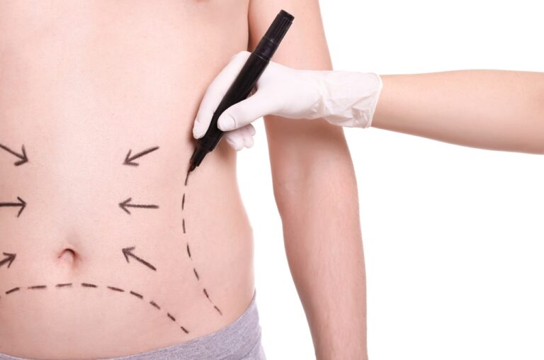 stomach marks drawn by surgeon in white latex glove