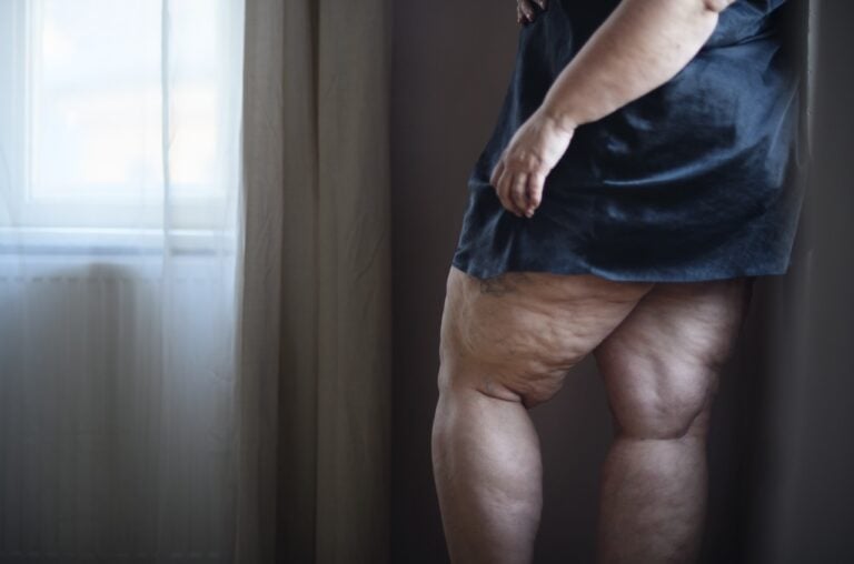 fat woman in blue dress with lipedema