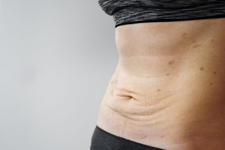 woman belly with excess scar tissues