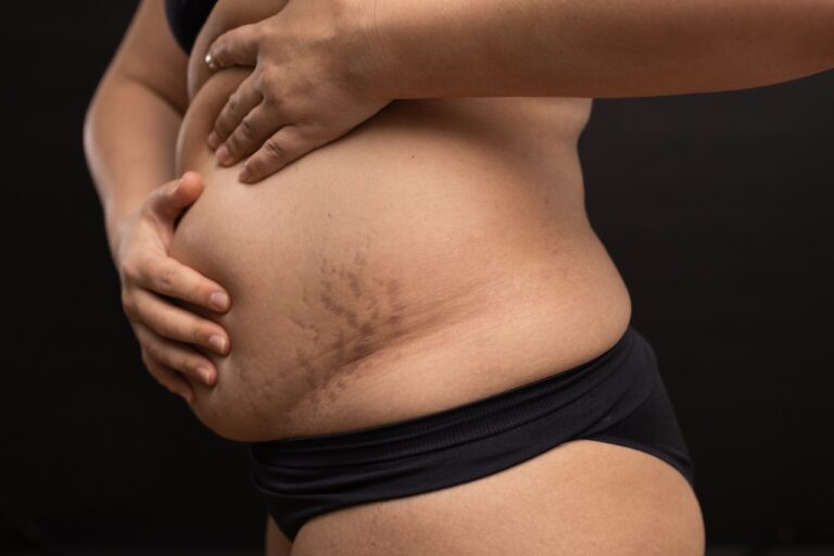 woman with big belly and stretch marks
