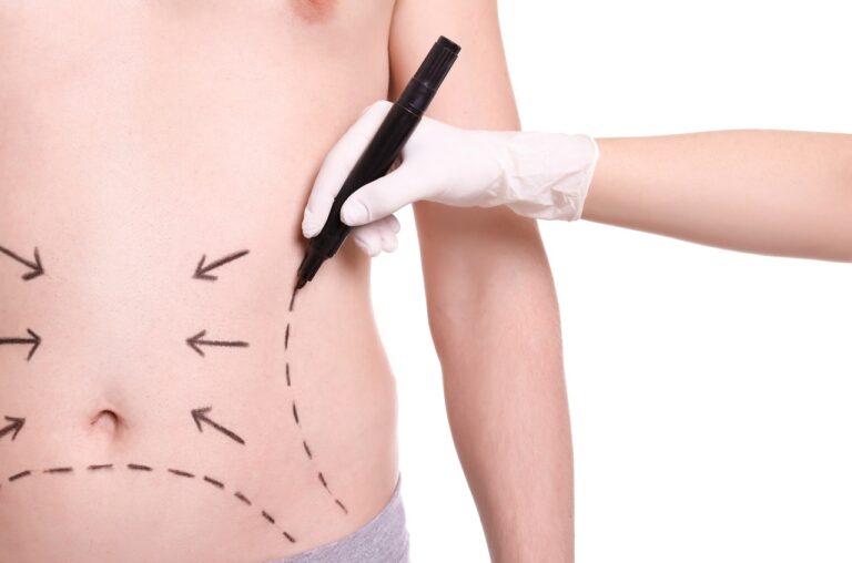 surgeon drawing marks on male stomach