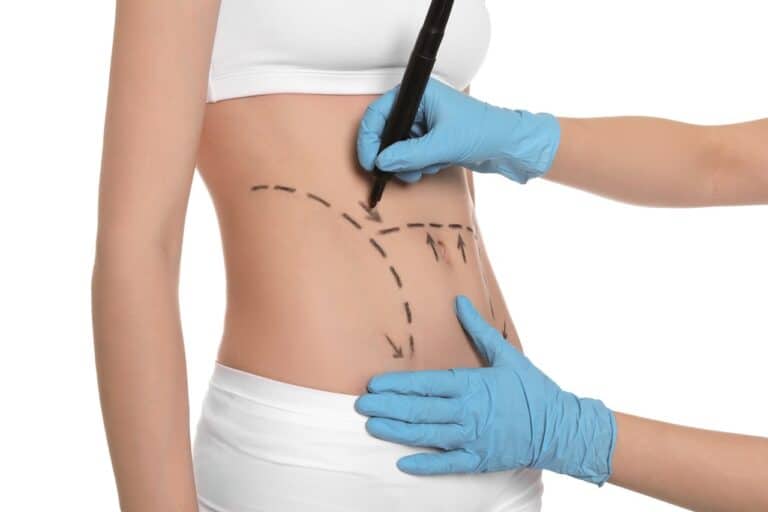 surgeon drawing marks on female belly