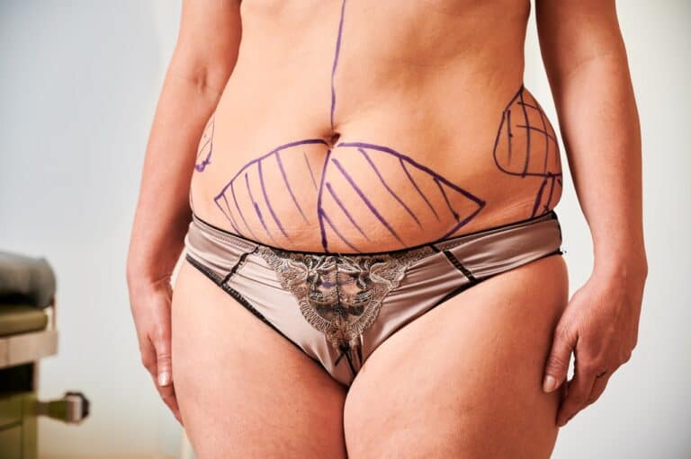 older woman body marks for liposuction