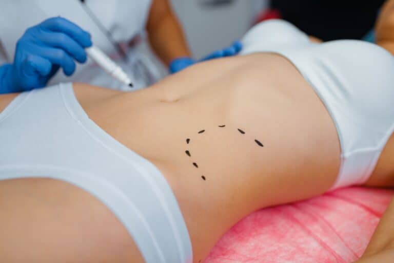 patient with little liposuction mark