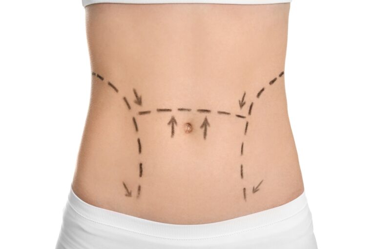 woman with liposuction marks across her belly
