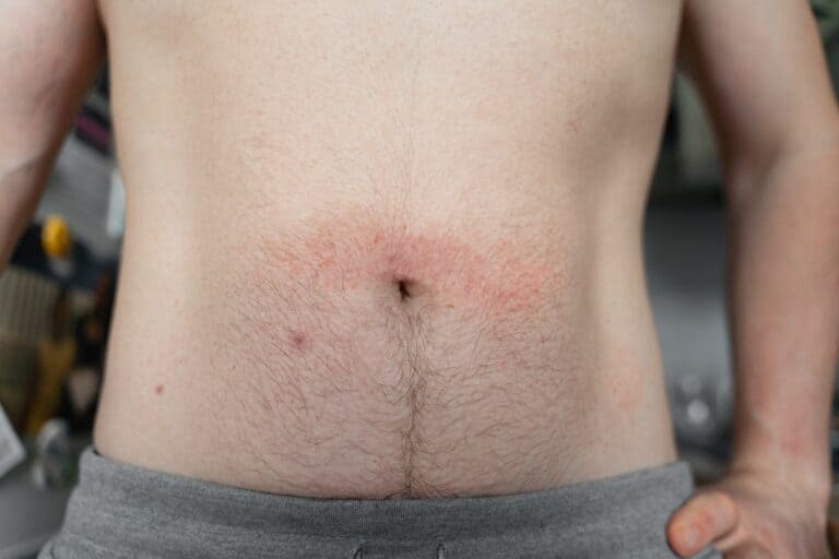 close up of a man's belly with red spots