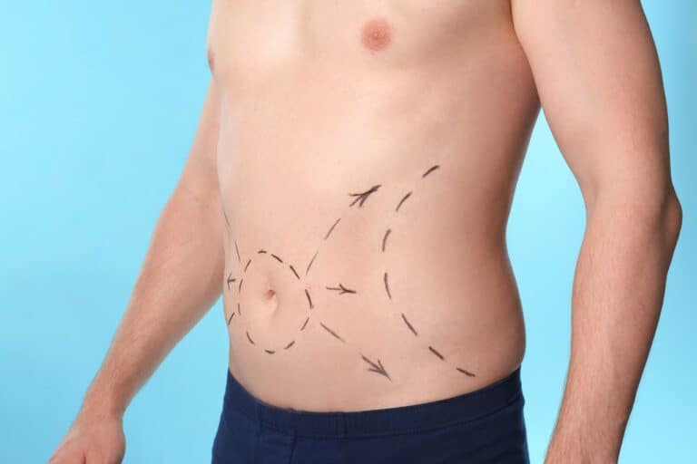 man with liposuction marks across his abdomen