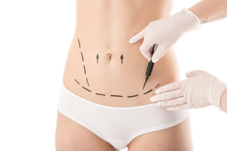 the abdomen of a woman getting marks from a plastic surgeon