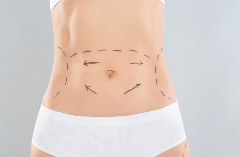 woman with marks on body for cosmetic procedure
