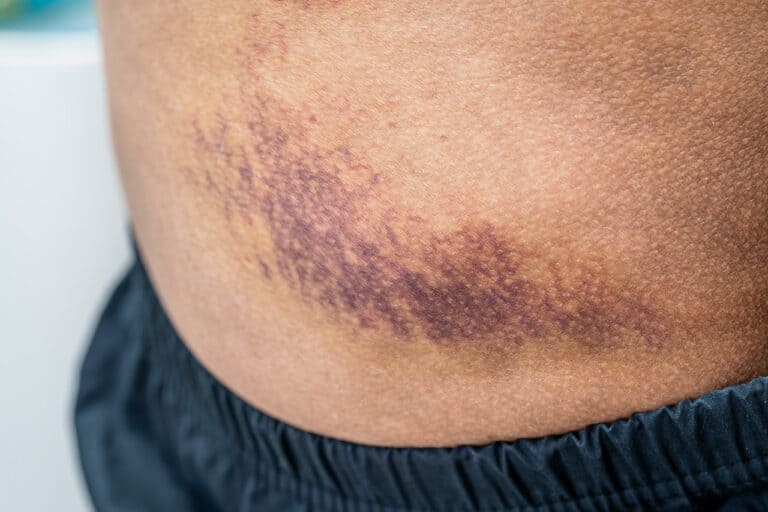 close up of bruise on the skin