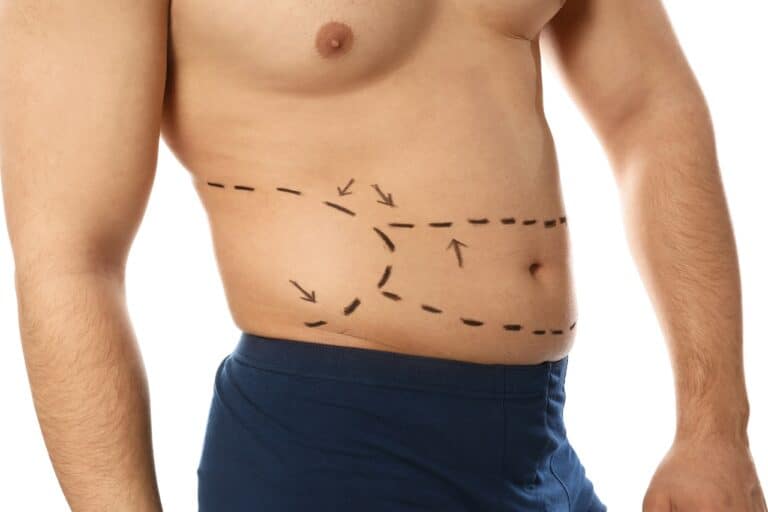 man's body with liposuction markings